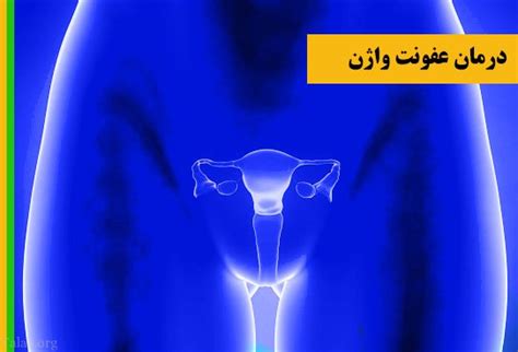 چرا زنان دچار عفونت واژن می شوند؟ علت و درمان عفونت واژن