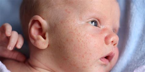 Baby Rash Treatment Heat Face Neck Era Organics