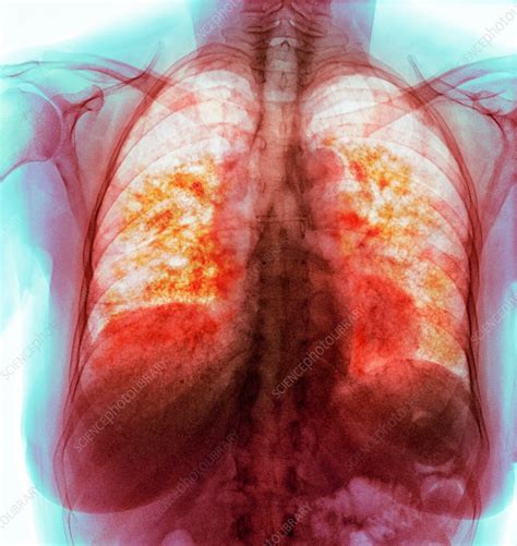 Pulmonary Fibrosis Coloured X Ray Stock Image C0372859 Science