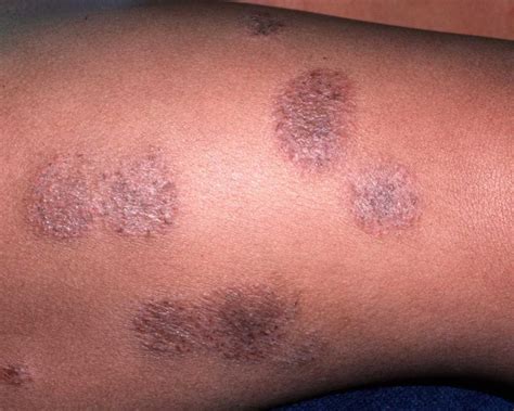 Mucormycosis or black fungus is a serious but rare fungal infection due to a rare killer fungus called mucor which exists in the environment, often found on wet surfaces. RINGWORM: NATURAL REMEDIES YOU CAN DEPEND ON - vibe.ng