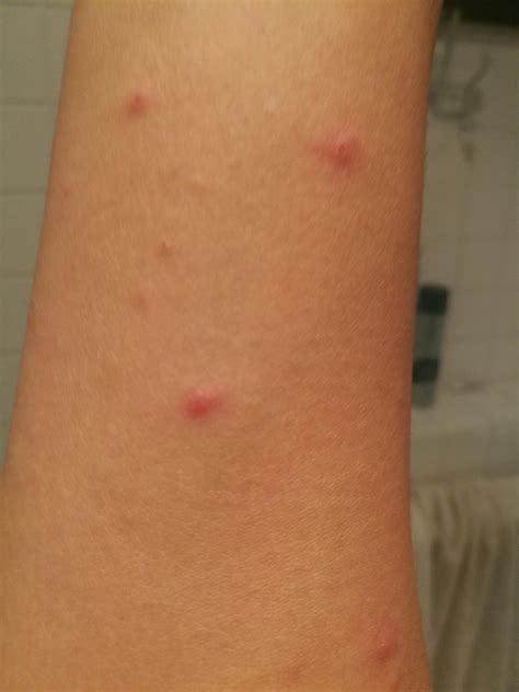 Red Itchy Bumps On The Skin Causes Picture Symptoms Treatment