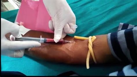 As with humans, a small blood sample is taken to ensure the dog can donate. how to draw blood from a vein? - YouTube