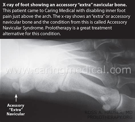 43 Accessory Navicular Syndrome Home Treatment Home