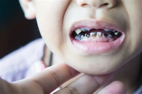 Should You Treat Baby Tooth Cavities