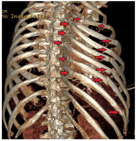 Management Of Traumatic Rib Fractures Wfsa Resources