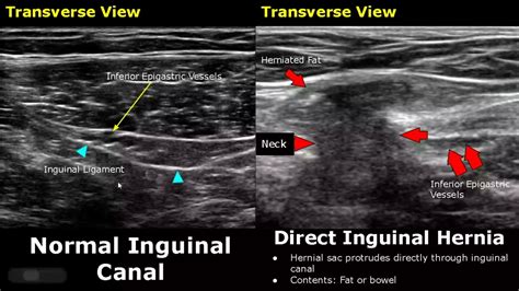 Indirect Vs Direct Hernia Anatomy
