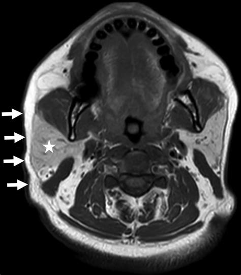 Parotid Gland Enlargement In Acromegaly A Case Report Of This Rare