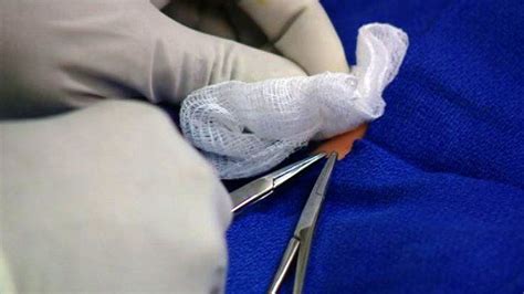 A Doctor S Guide To Male Circumcision Bbc News