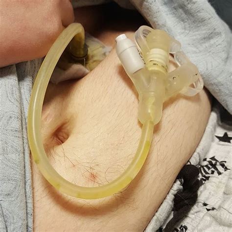 A Close Up Of A Person With An Oxygen Tube Attached To Their Stomach