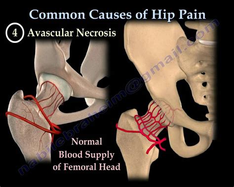 Hip Pain Common Causes Everything You Need To Know Dr Nabil Ebraheim Youtube