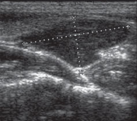 Longitudinal Usg Shows A Large Parathyroid Adenoma Inferior To The Left
