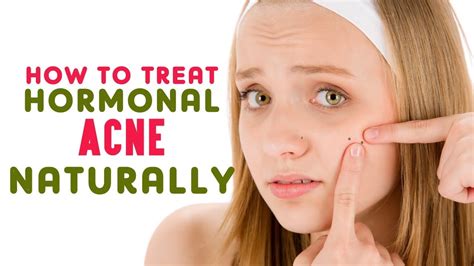 How To Treat Hormonal Acne Naturally Youtube