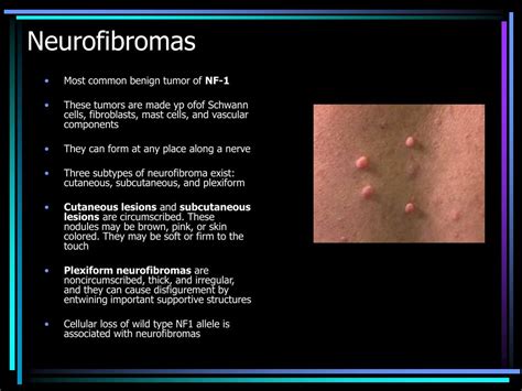 Ppt Neurofibromatosis Powerpoint Presentation Free Download Id4501586