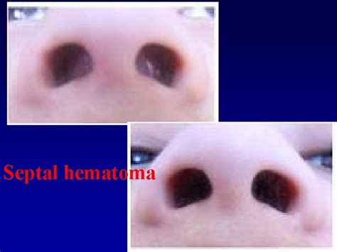 Blood Supply Of Nasal Septum Ant Ethmoidal A