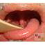 Elongated Long Uvula Causes Symptoms And Treatment