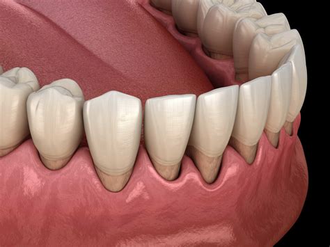 Gum Recession Pinhole Surgical Technique Grafting