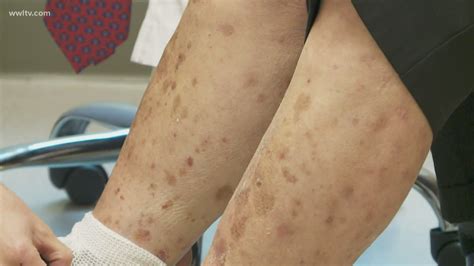 New Psoriasis Treatment Uses Light Therapy How To Get In On The Study