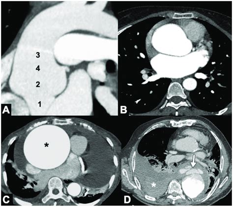 Cta Of Thoracic Aorta Aneurysms A Marfan Syndrome A Multisystem
