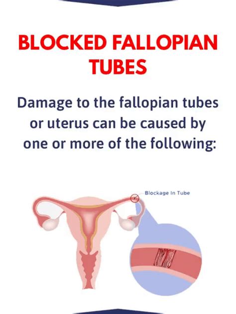 Pelvic Inflammatory Disease A Leading Cause Of Fallopian Tube Damage