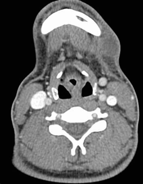 Second Branchial Cleft Cyst Left Submandibular Swelling And Erythema