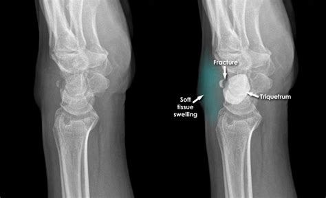 Trauma X Ray Upper Limb Gallery 2 Wrist Triquetrum Fracture