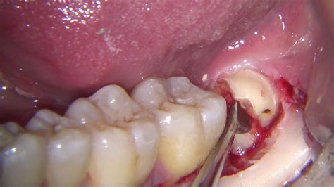 Fast Lower Wisdom Tooth Surgical Extraction Youtube