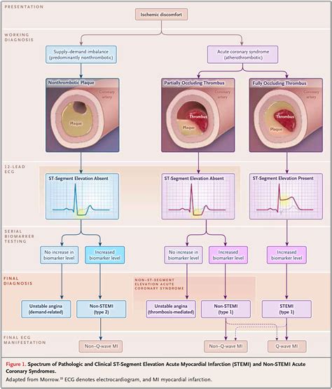 An inferoposterior infarction causes some degree of rv dysfunction in about half of patients and causes hemodynamic abnormality in 10 to 15%. Acute Myocardial Infarction | NEJM Resident 360