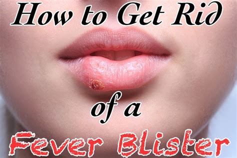 How To Get Rid Of A Fever Blister Healthy Focus