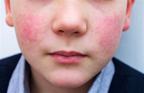 Top 4 Things You Need To Know About Slapped Cheek Disease Archynewsy