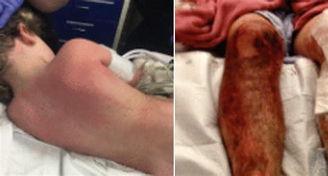 Rare Case of Wet Cement Burn, Alkali Burn in 7-Year-Old Boy