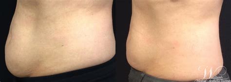 Coolsculpting® Before And After Pictures Case 5 The Woodlands Tx Woodlands Medical