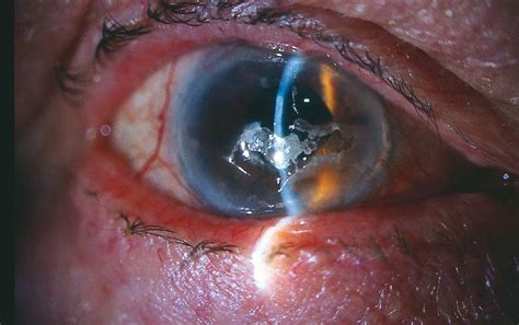 Cornea Review Questions In Ophthalmology