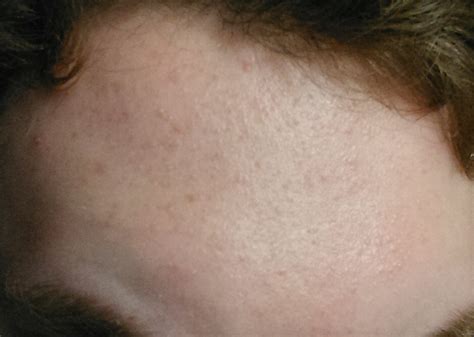 Small Colorless Bumps All Over Forehead General Acne Discussion