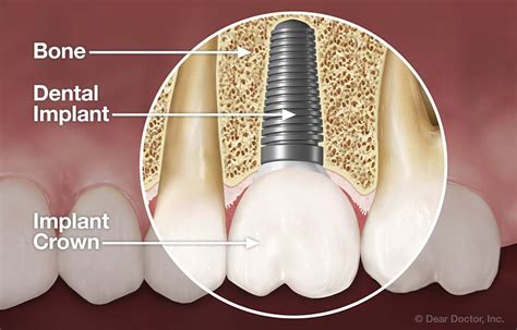 Dental Implant Dentistry Show Your Grin Dental Olathe Ks