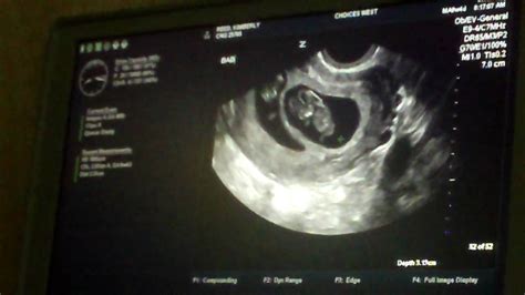 Fraternal Twins Ultrasound At 9 Weeks 4 Days Youtube