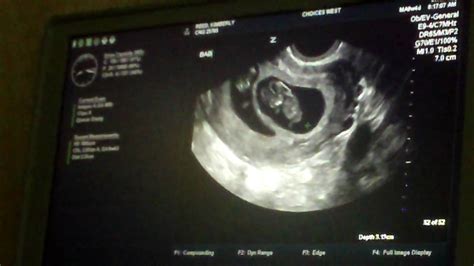 Fraternal Twins Ultrasound At 9 Weeks 4 Days YouTube