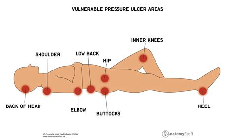 Pressure Ulcer Care Treatment Wound Care Anatomystuff