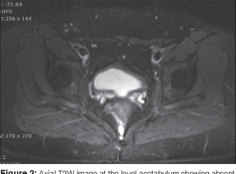 Figure 2 From Magnetic Resonance Imaging Diagnosis Of Mayer Rokitansky