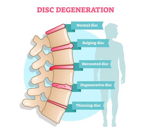 The 3 Stages Of Degenerative Disc Disease New Jersey Comprehensive