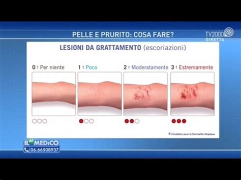 Petecchie interno guancia - definizione