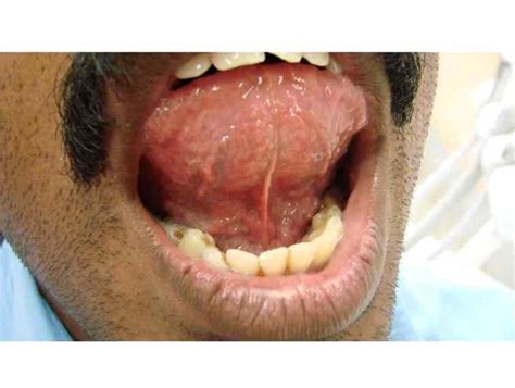 Ventral Tongue Surface