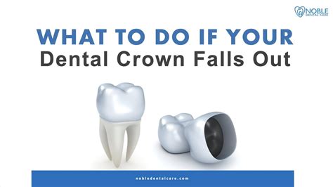 What To Do If Your Dental Crown Falls Out Youtube