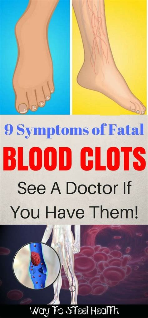 9 Symptoms Of Fatal Blood Clots See A Doctor If You Have Them