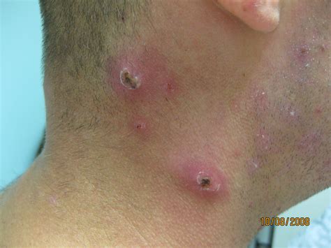 Folliculitis And Boils Dermboard