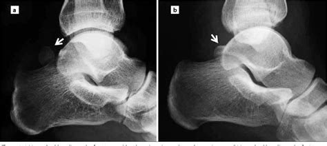 Figure 9 From The Accessory Ossicles Of The Foot And Ankle A