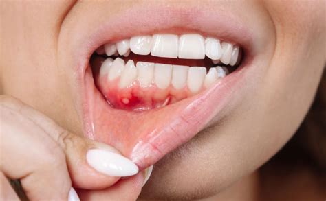 Abscess In The Mouth Diagnosis And Treatment Swiss Dent