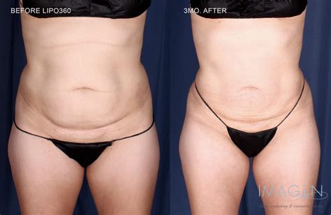 Lipo Omaha NE Omaha Liposuction By Imagen