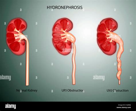 Hydronephrosis Stock Photos And Hydronephrosis Stock Images Alamy