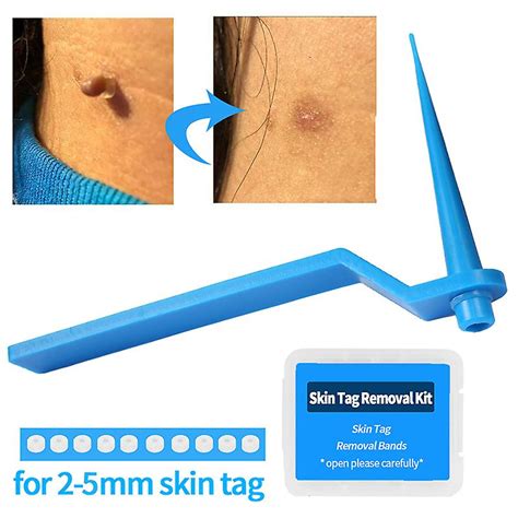 3pack home use micro skin tag rubber band removal kit skin micro tag refill band pack fruugo uk