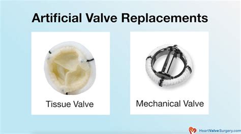 Mitral Valve Awareness How Is Mitral Valve Disease Treated